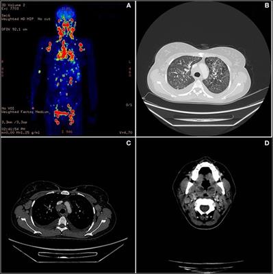 First Occurrence of Plasmablastic Lymphoma in Adenosine Deaminase-Deficient Severe Combined Immunodeficiency Disease Patient and Review of the Literature